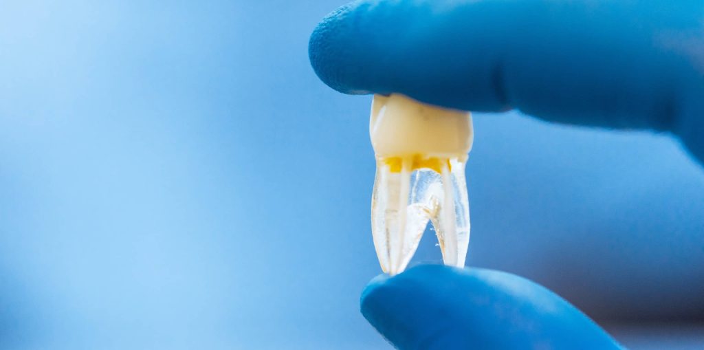 reasons why some root canal treatments fail 1024x509