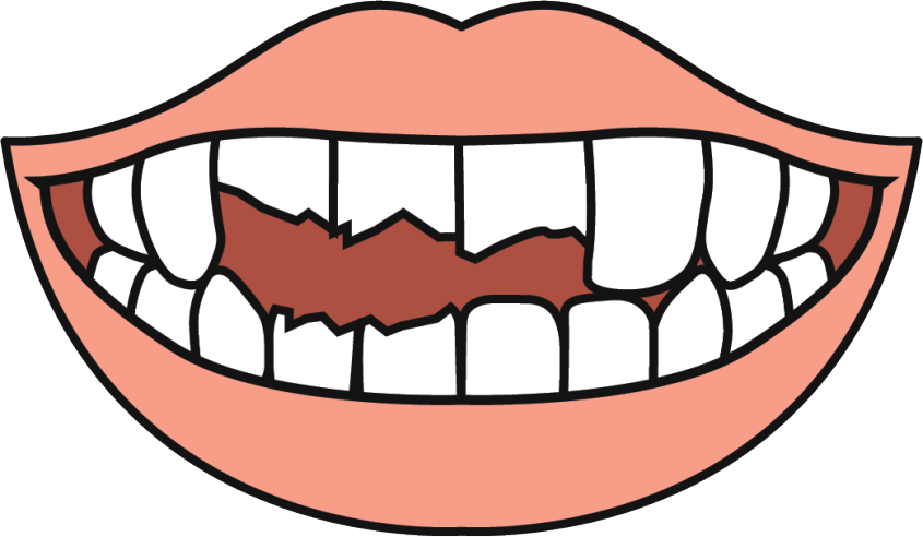 cracked and chipped tooth min