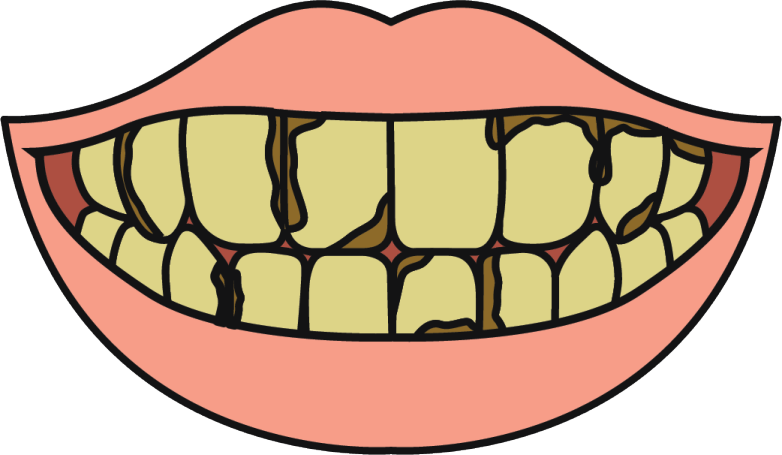 severe tooth decay2x min